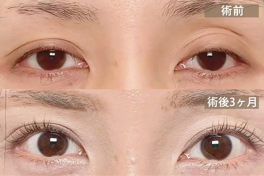 腱膜性眼瞼下垂（後天性眼瞼下垂）　岡山