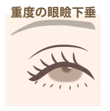重度の眼瞼下垂　岡山