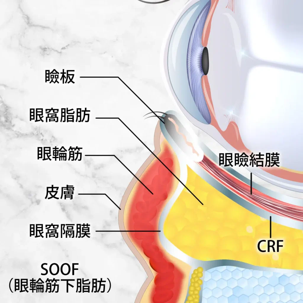 eクリニック福岡院の裏ハムラの図解（名医の田嶋隼也医師が執刀）