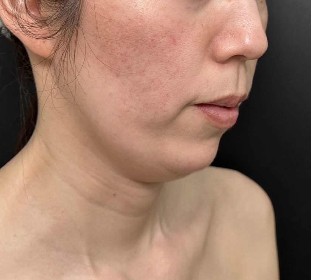 eクリニック岡山院の顎下脂肪吸引の症例（名医の田嶋隼也医師が執刀）