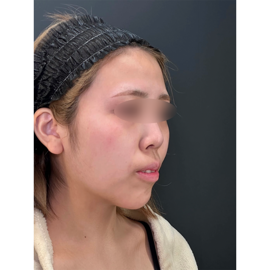 eクリニック岡山院の鼻フル整形（鼻尖形成3D法＋耳介軟骨移植＋鼻柱下降＋プロテーゼ）の症例術前写真（名医の田嶋隼也医師が執刀）