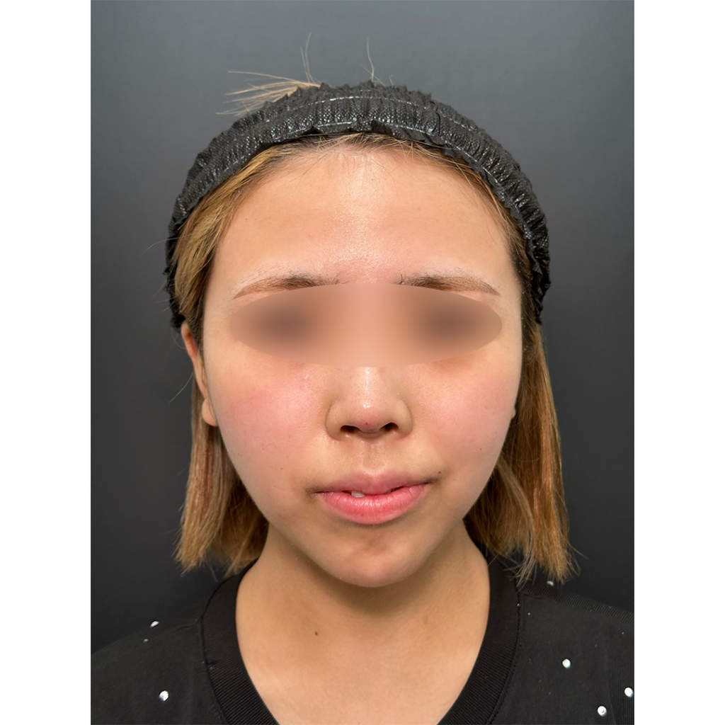 eクリニック岡山院の鼻フル整形（鼻尖形成3D法＋耳介軟骨移植＋鼻柱下降＋プロテーゼ）の症例術後1ヶ月写真（名医の田嶋隼也医師が執刀）