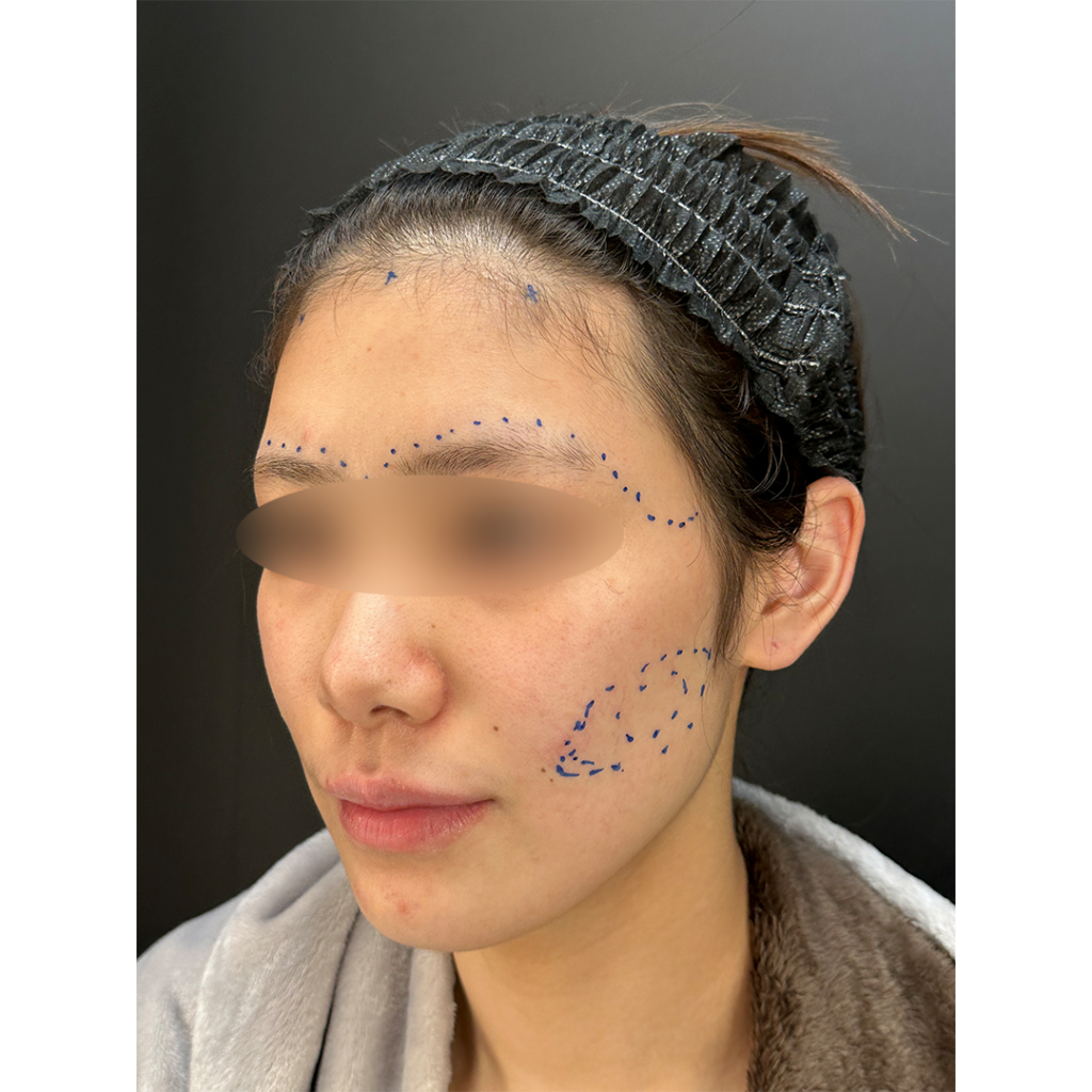 eクリニック岡山院の脂肪注入の症例（術前デザイン）（名医の田嶋隼也医師が執刀）