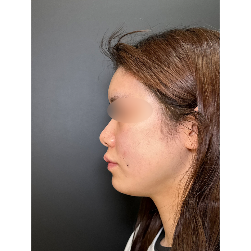 eクリニック岡山院の脂肪注入の症例（術直後）（名医の田嶋隼也医師が執刀）