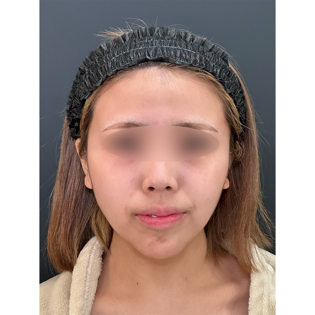 eクリニック岡山院の鼻フル整形（鼻尖形成3D法＋耳介軟骨移植＋鼻柱下降＋プロテーゼ）の症例術前写真（名医の田嶋隼也医師が執刀）