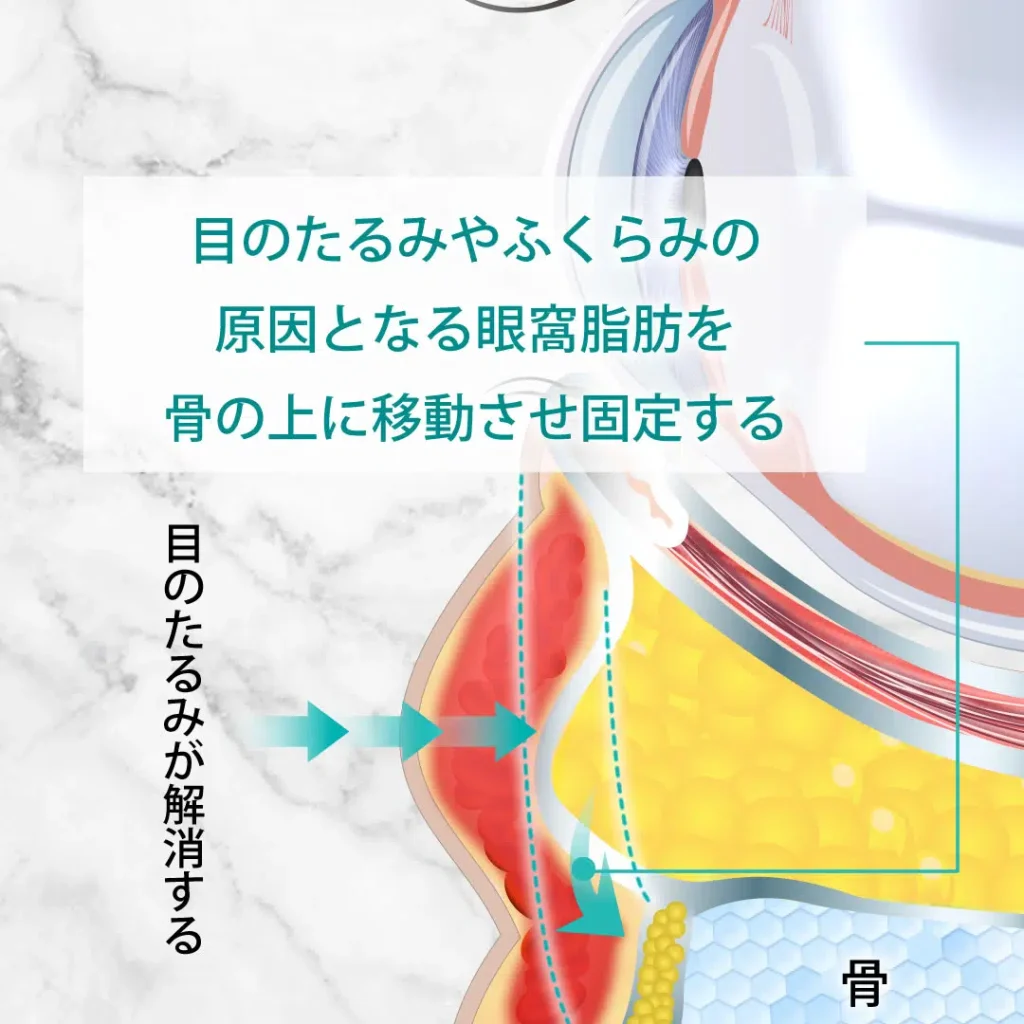 eクリニック福岡院の裏ハムラの図解（名医の田嶋隼也医師が執刀）