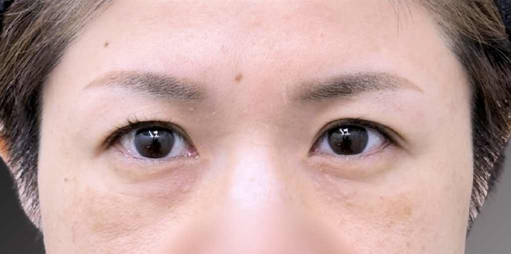 eクリニック福岡院の裏ハムラの症例術前写真（名医の田嶋隼也医師が執刀）