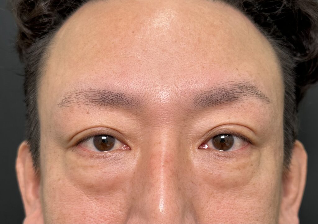 eクリニック岡山院のクマ取り（脱脂＋目の下脂肪注入）の症例術前写真（名医の田嶋隼也医師が執刀）
