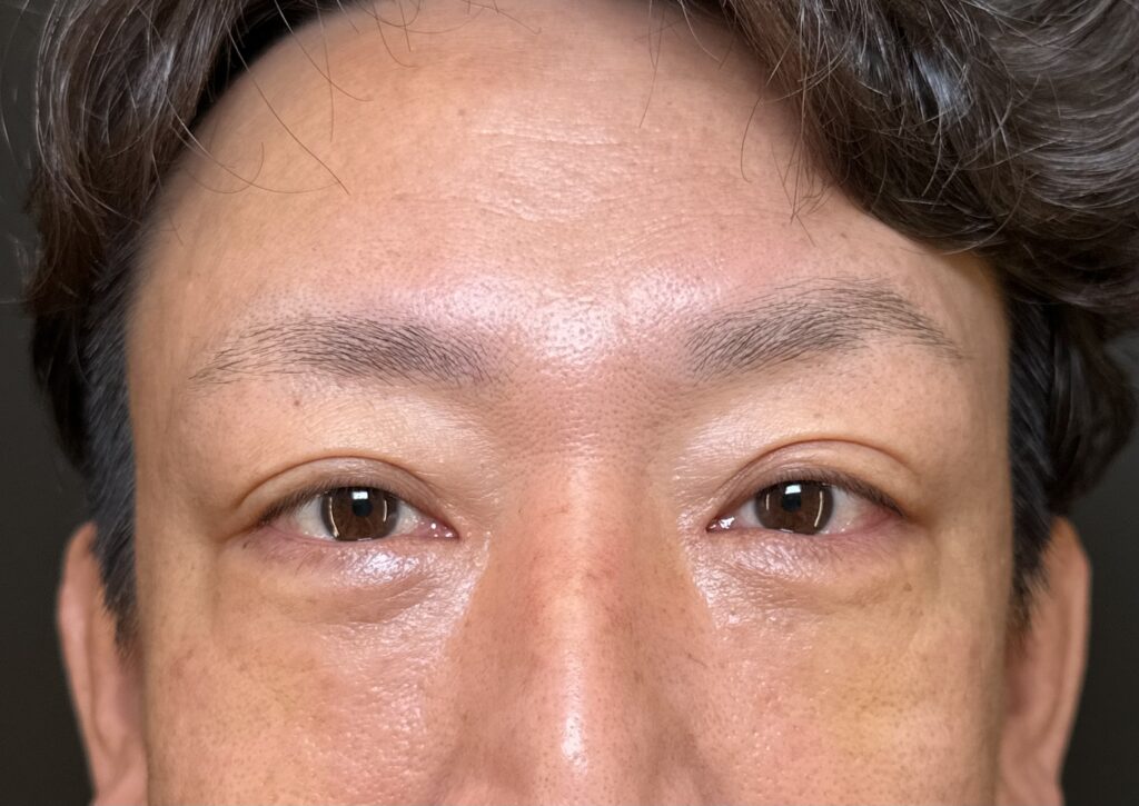 eクリニック岡山院のクマ取り（脱脂＋目の下脂肪注入）の症例術後1ヶ月写真（名医の田嶋隼也医師が執刀）