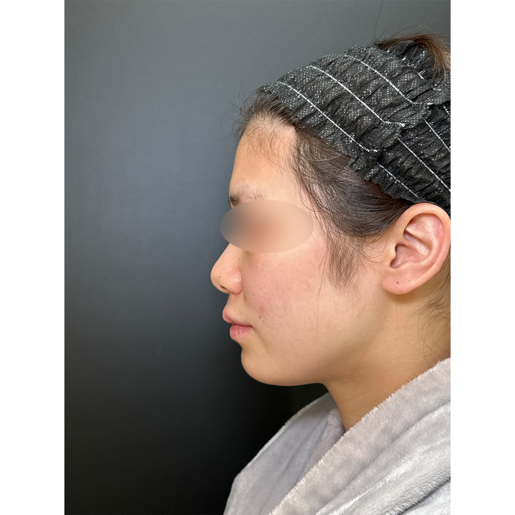 eクリニック岡山院の脂肪注入の症例（術前）（名医の田嶋隼也医師が執刀）