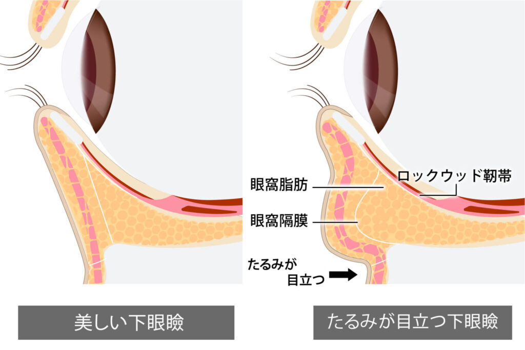 eクリニック岡山院の眼窩脂肪の図解