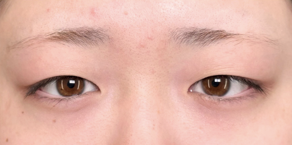 eクリニック岡山院の二重整形（自然癒着法）の症例術前写真（名医の田嶋隼也医師が執刀）