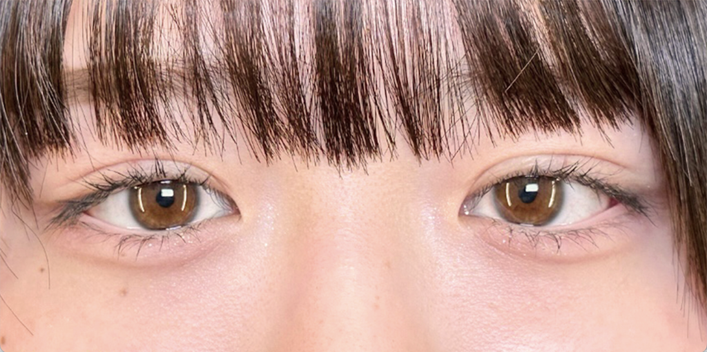 eクリニック岡山院の二重整形（自然癒着法）の症例術後1ヶ月写真（名医の田嶋隼也医師が執刀）