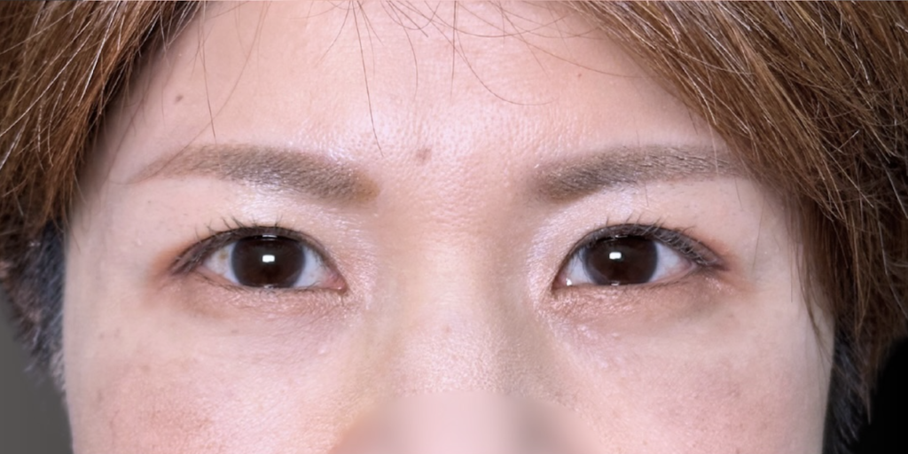 eクリニック福岡院の裏ハムラの症例術後1ヶ月写真（名医の田嶋隼也医師が執刀）