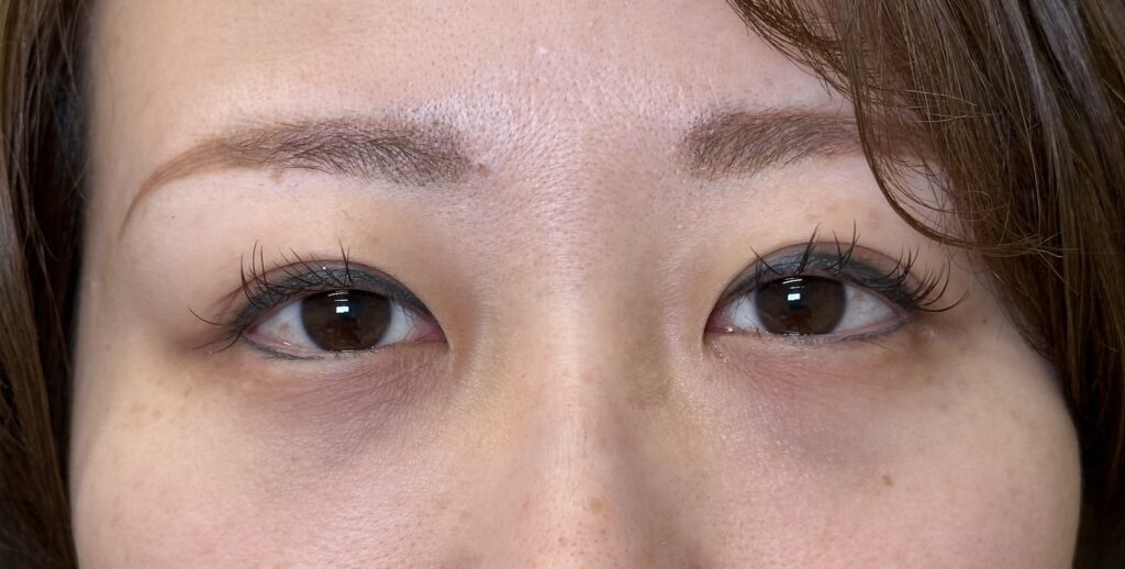 eクリニック岡山院のクマ取り裏ハムラの症例写真(名医の田嶋隼也医師が執刀)