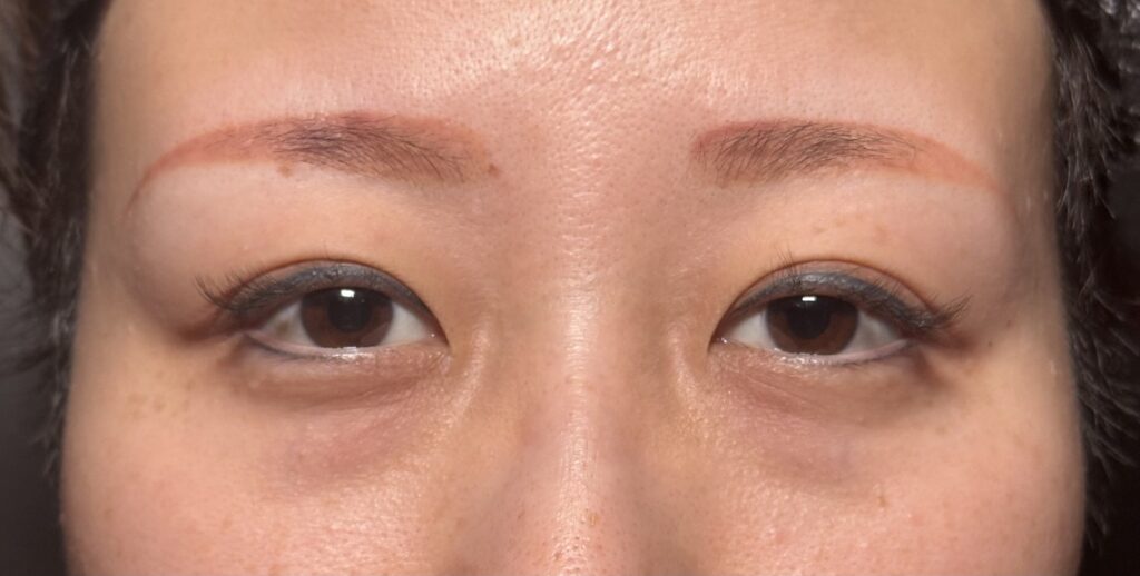 eクリニック岡山院のクマ取り裏ハムラの症例写真(名医の田嶋隼也医師が執刀)