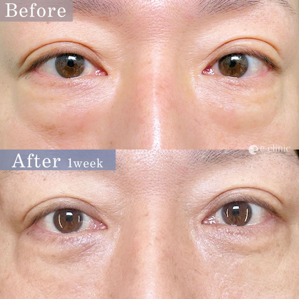 脱脂と脂肪注入の症例写真