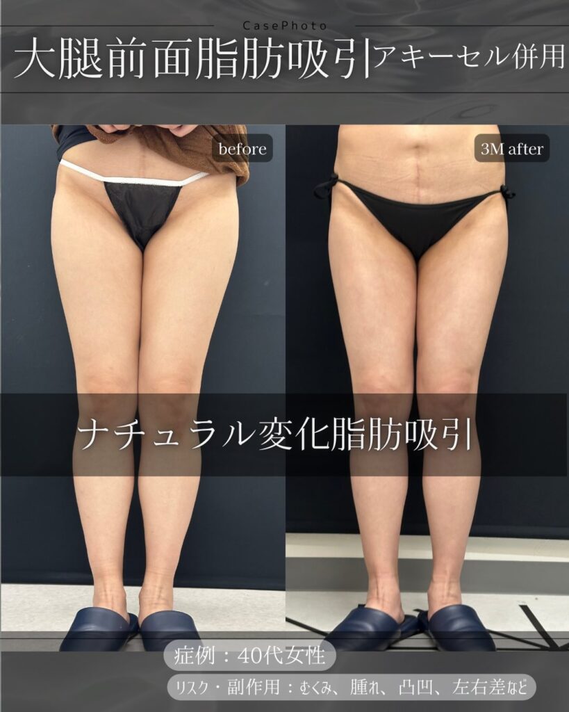 太腿前面の脂肪吸引の症例写真