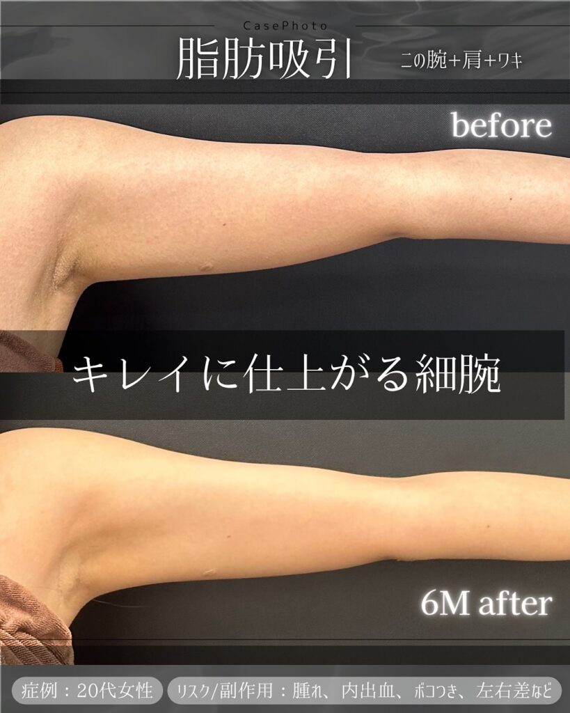 二の腕と肩と脇の症例写真 (2)
