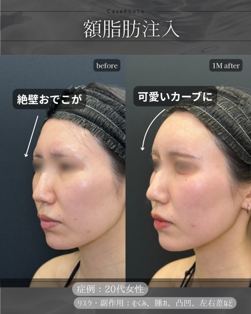 額の脂肪注入の症例写真