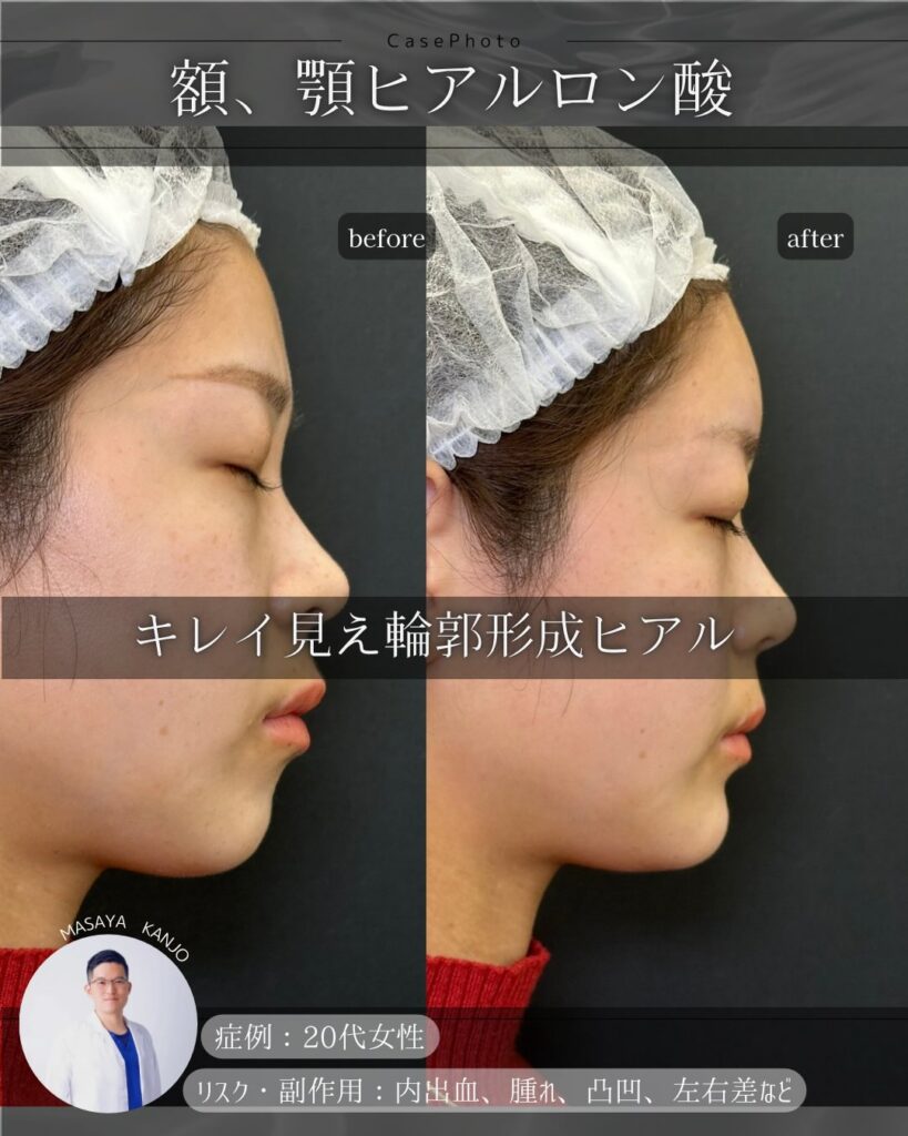 頬と顎のヒアルロン酸注入の症例写真