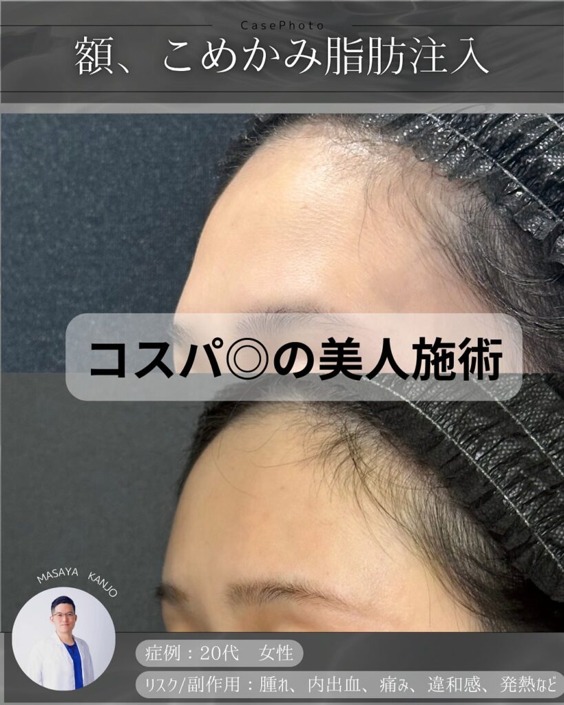 額とこめかみの脂肪注入の症例写真 (5)