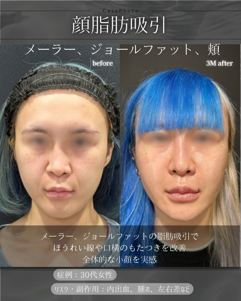 顔の脂肪吸引とメーラーファットとジョールファットの症例写真
