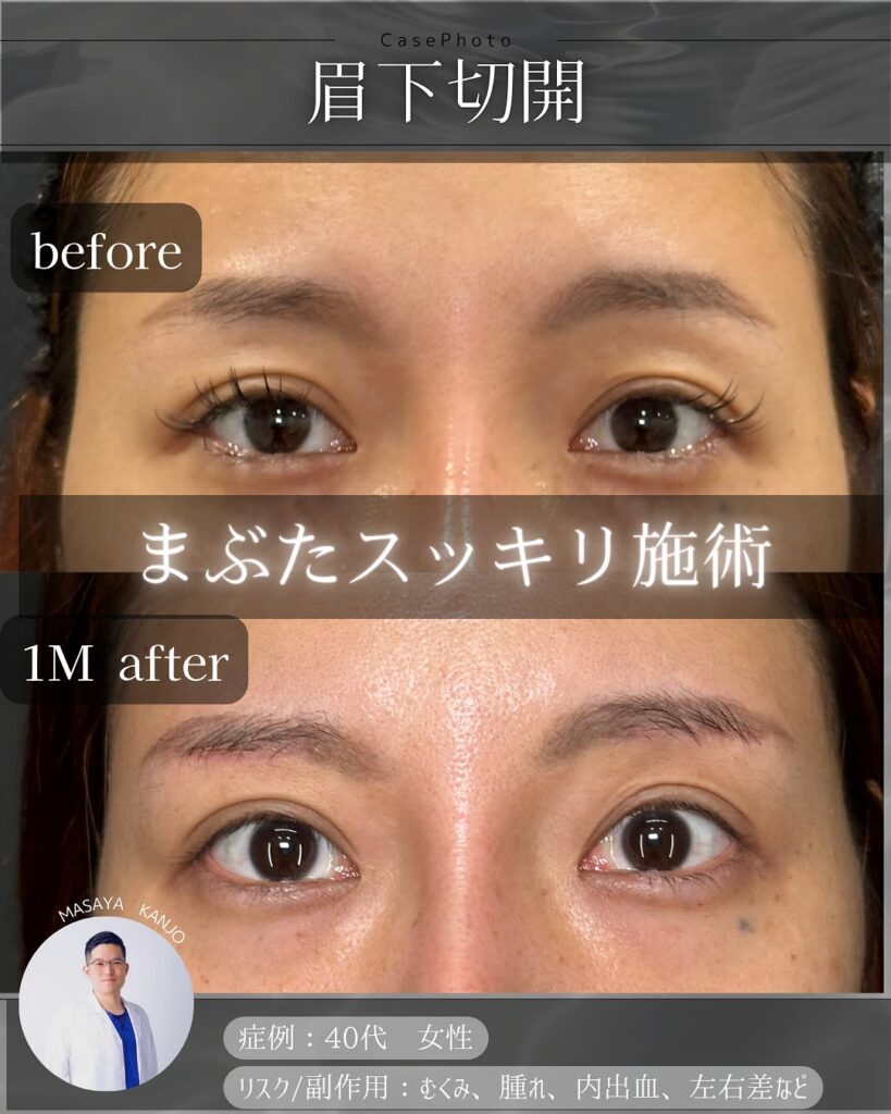 眉下切開の症例写真 (2)