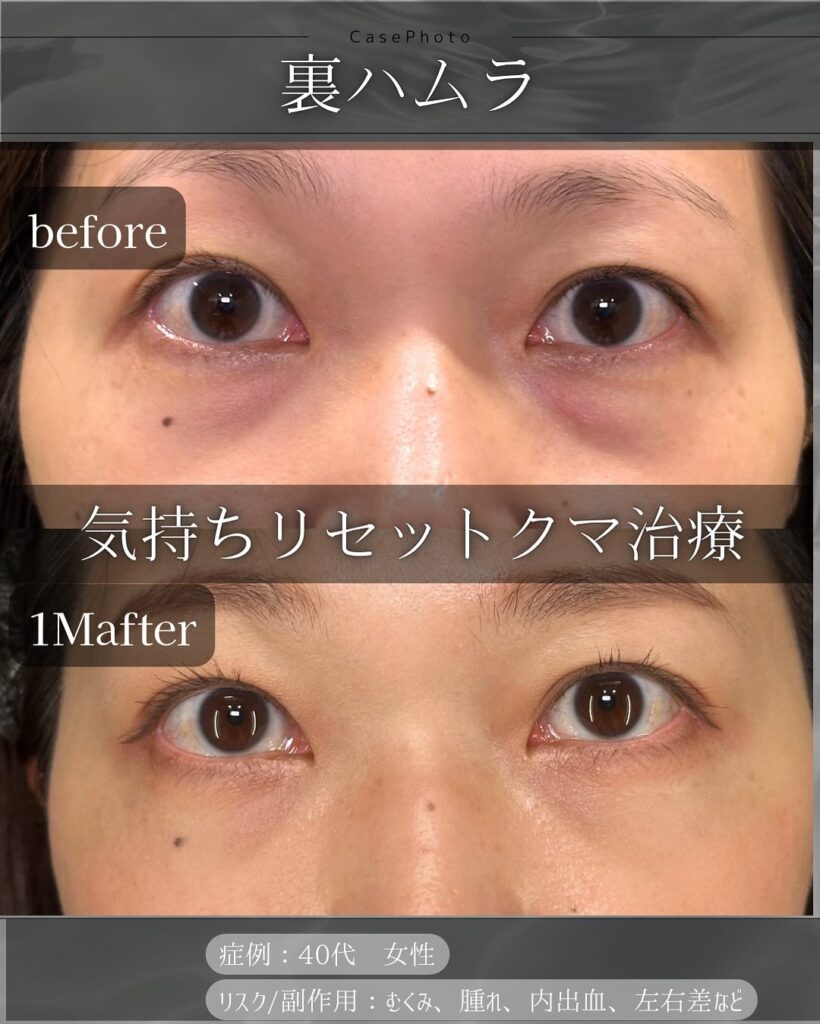 裏ハムラ法の症例写真 (32)