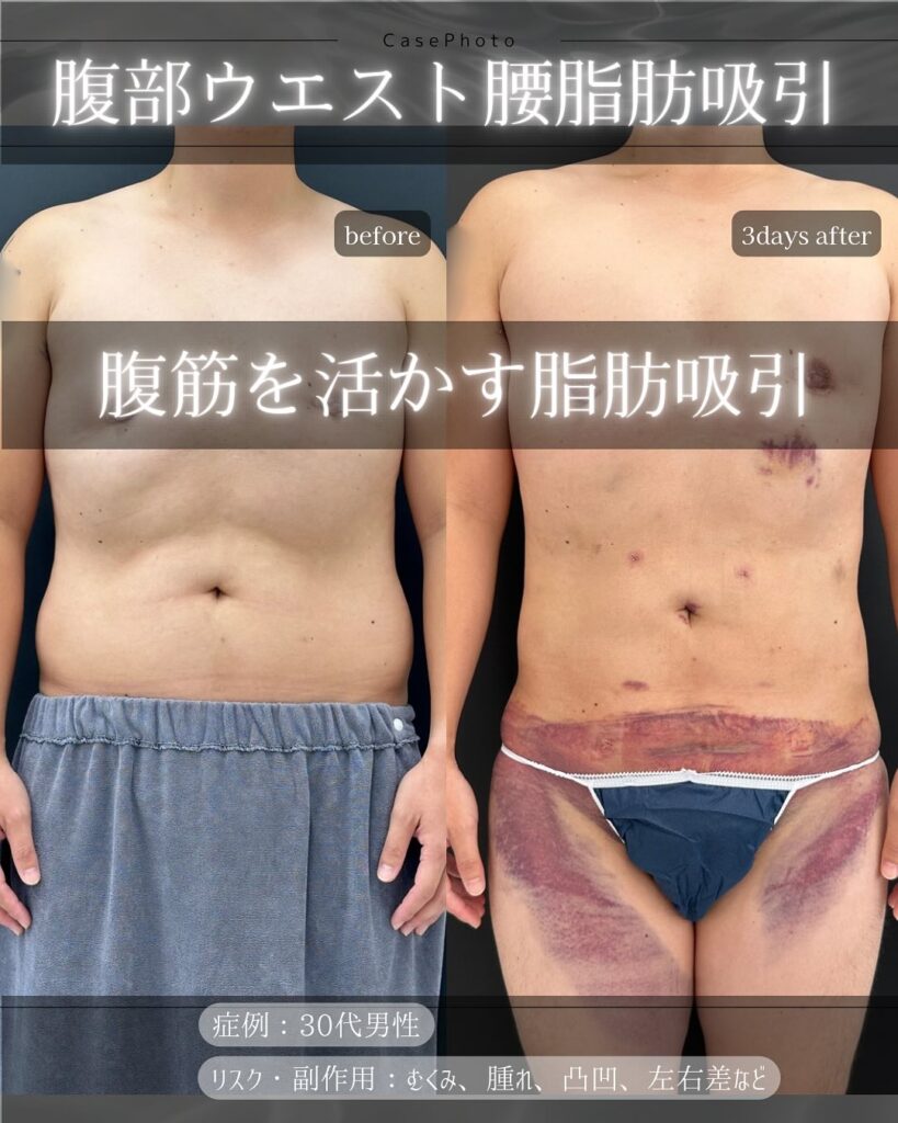 腹部と腰の脂肪吸引の症例写真