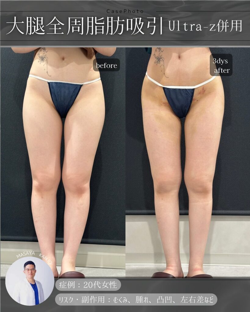 Ultra-Z併用大腿全周脂肪吸引の症例写真