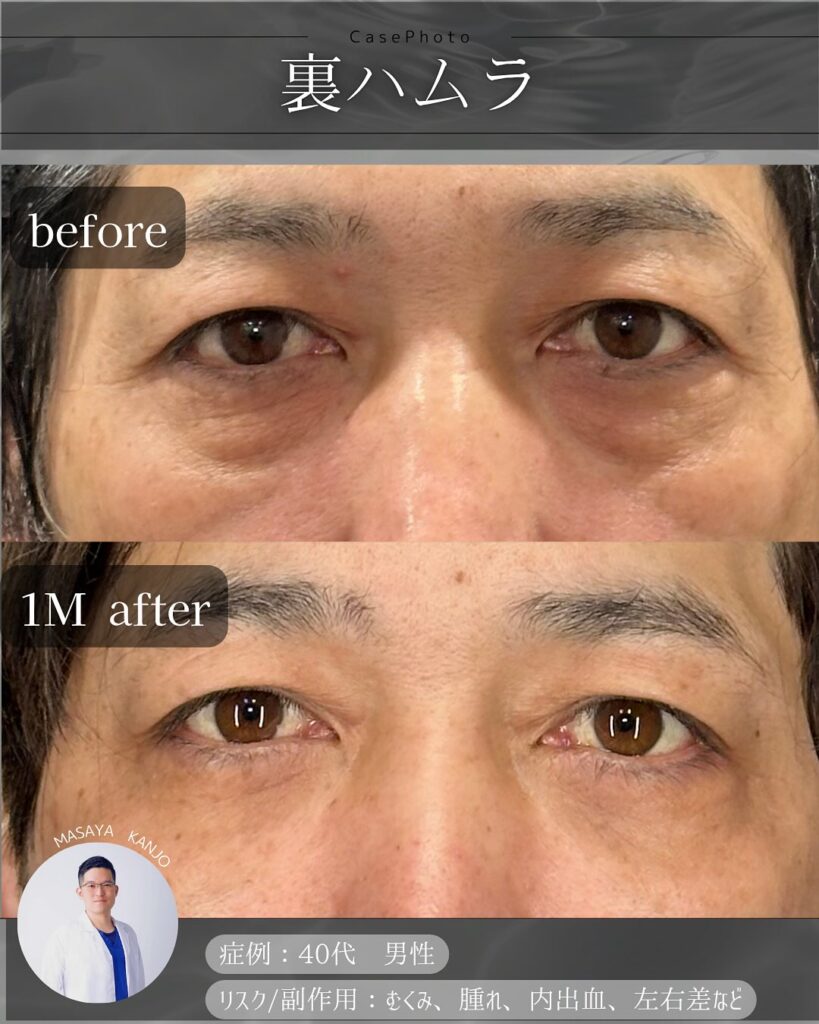 裏ハムラ法の症例写真 (31)