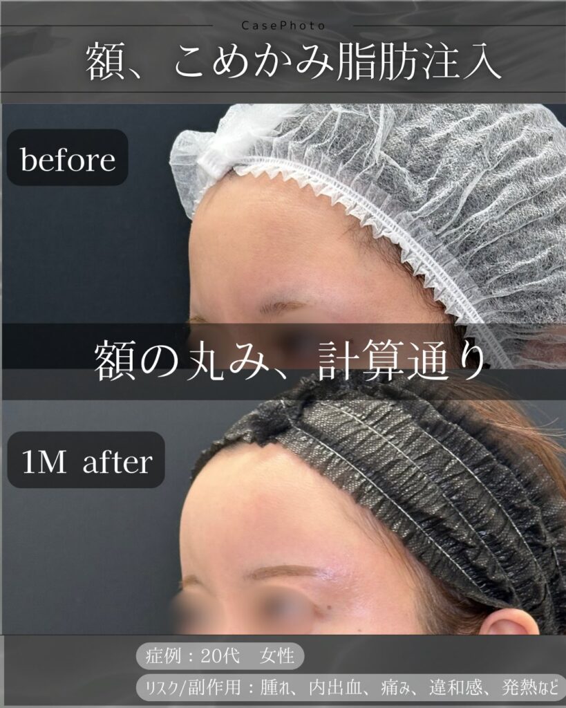 額とこめかみの脂肪注入の症例写真 (4)