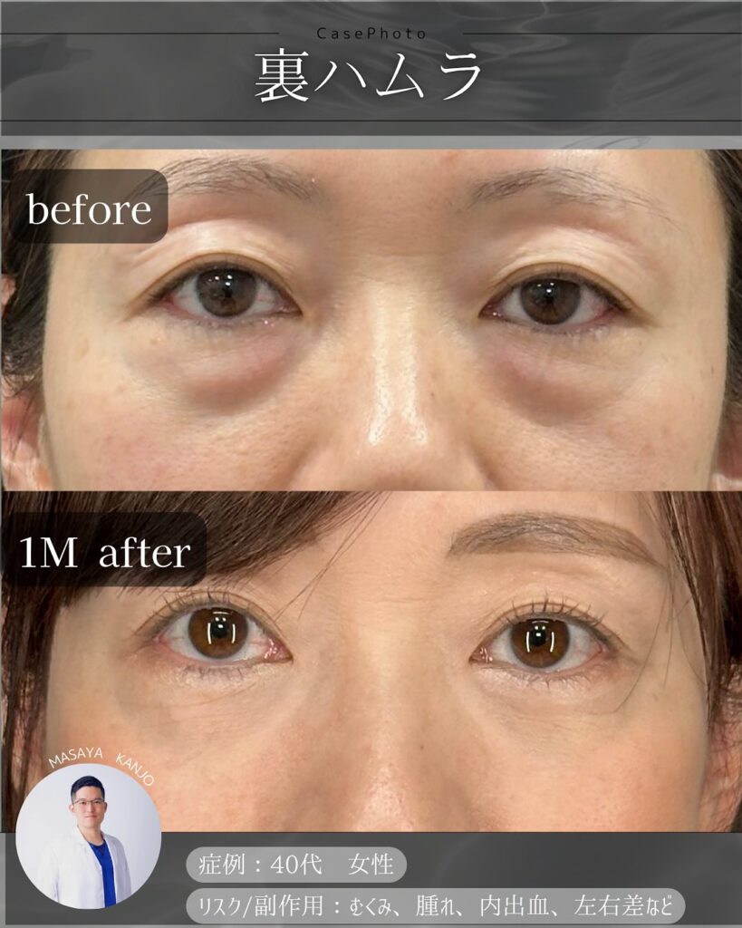 裏ハムラ法の症例写真 (29)