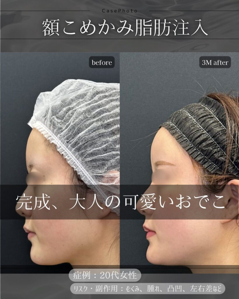 額とこめかみの脂肪注入の症例写真