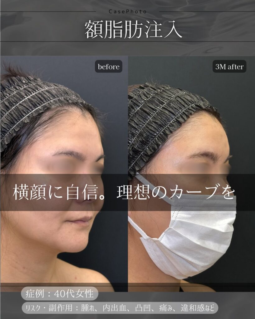 額の脂肪注入の症例写真 (2)
