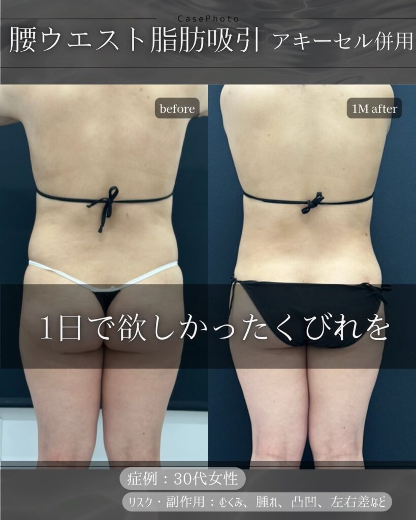 腰とウエストの脂肪吸引の症例写真