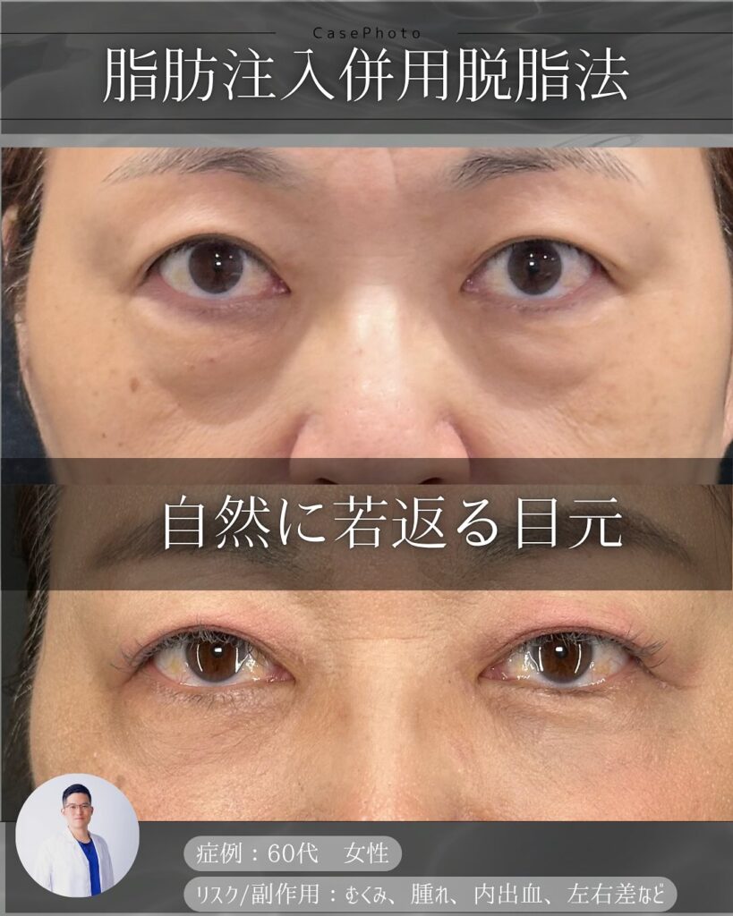 目の下の脂肪注入と脱脂の症例写真