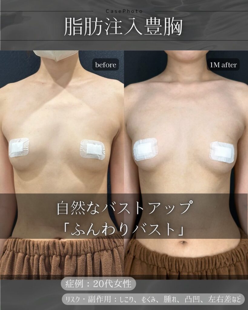 脂肪注入豊胸の症例写真 (3)