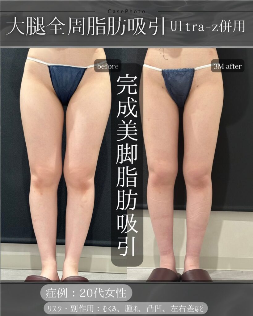 太もも全周の症例写真