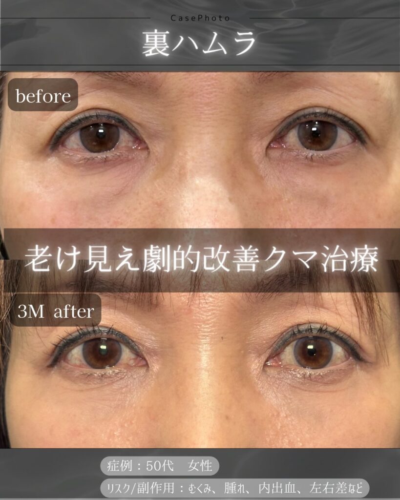 裏ハムラ法の症例写真 (30)