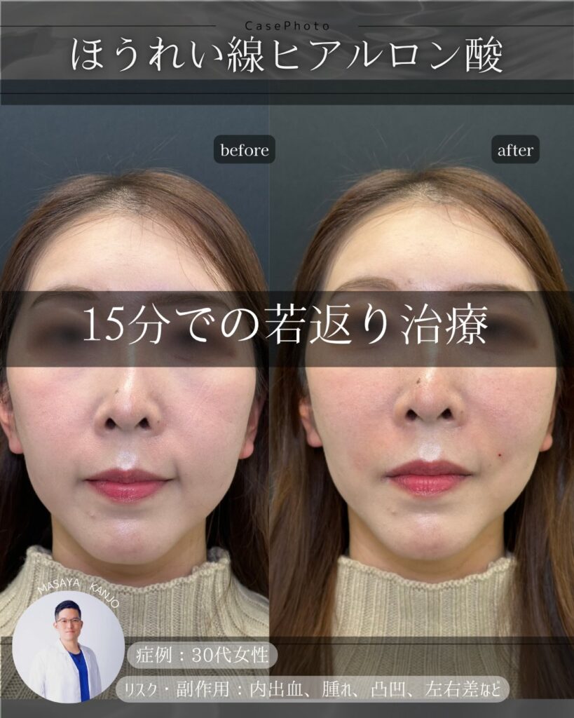 ほうれい線のヒアルロン酸の症例写真 (2)
