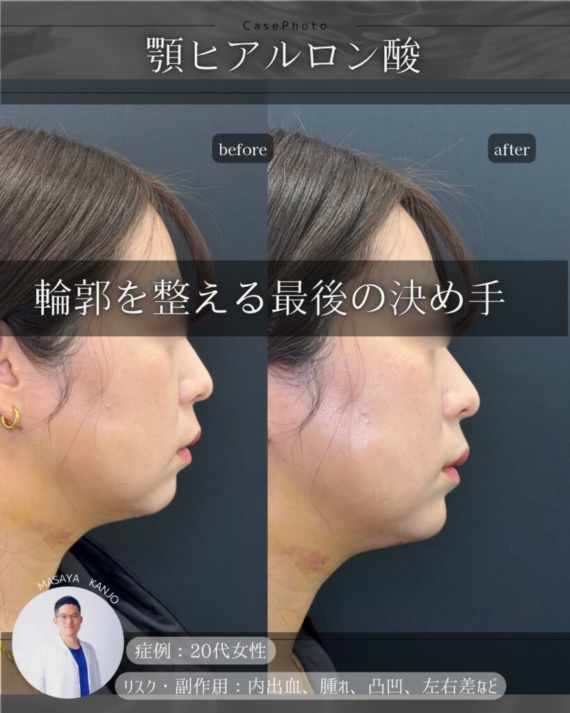 顎のヒアルロン酸症例写真