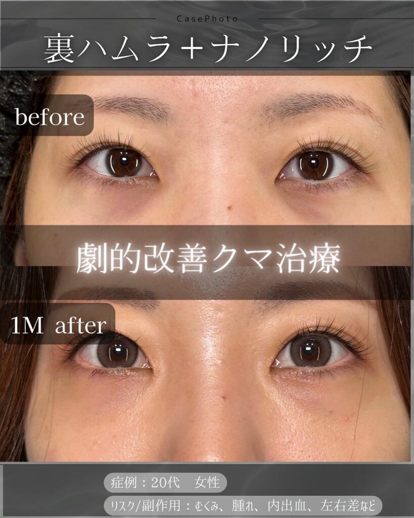 裏ハムラ法とナノリッチの症例写真