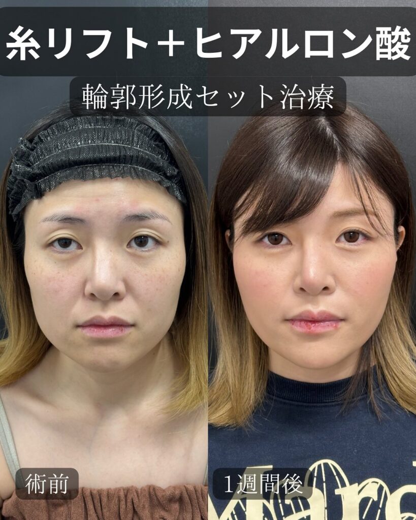 糸リフトとヒアルロン酸の症例写真