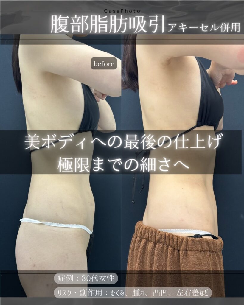 腹部の脂肪吸引