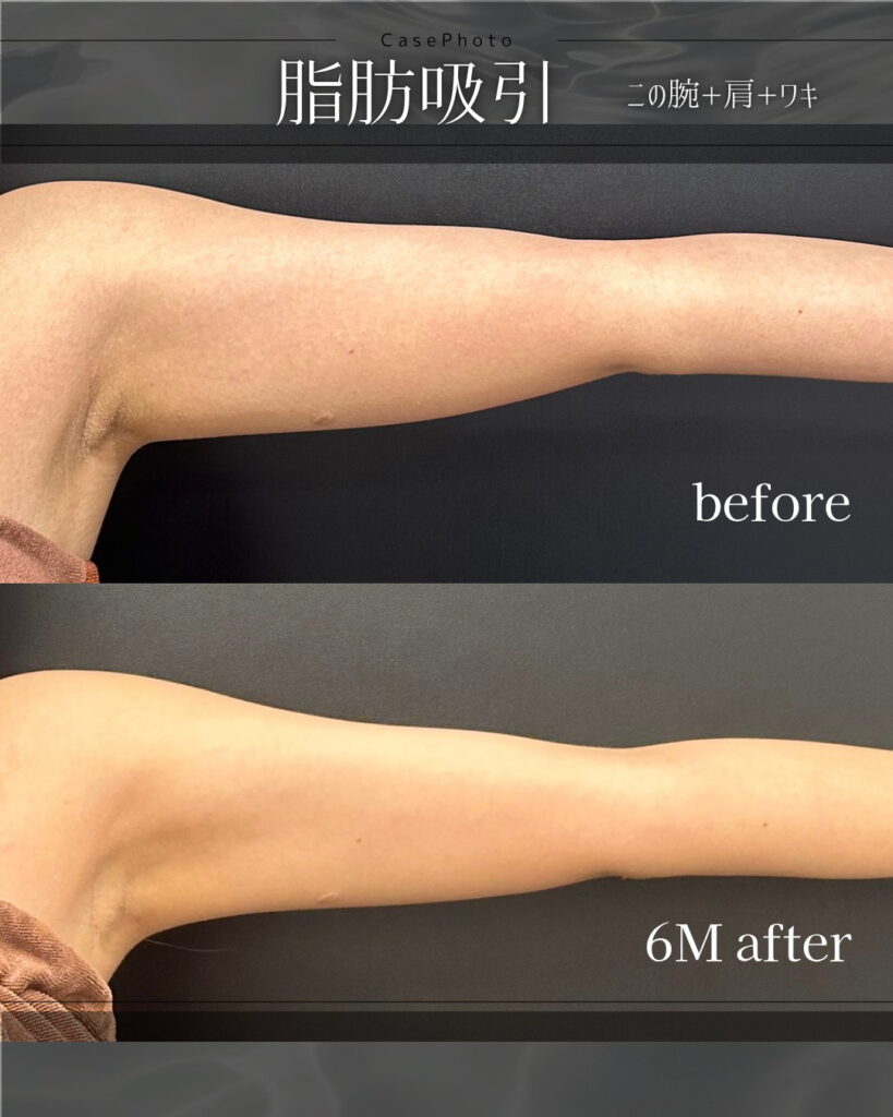 二の腕と肩とわきの脂肪吸引の症例写真