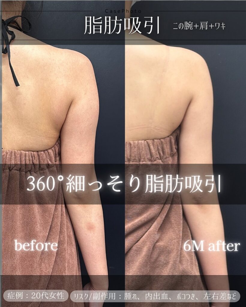 二の腕と肩と脇の症例写真