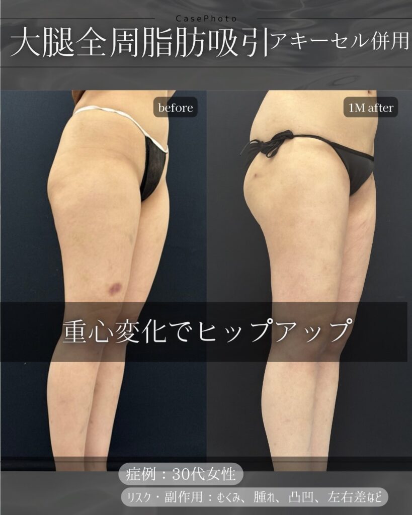 太もも全周の脂肪吸引の症例写真