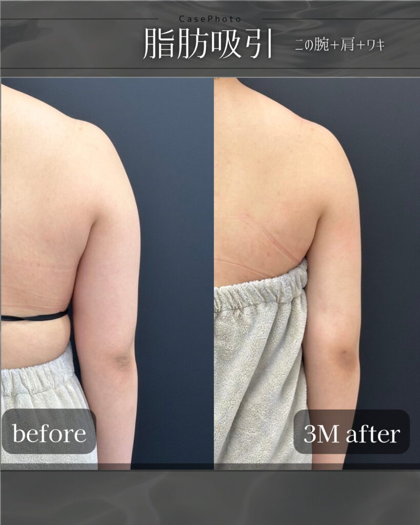 二の腕と肩と脇の脂肪吸引の症例写真